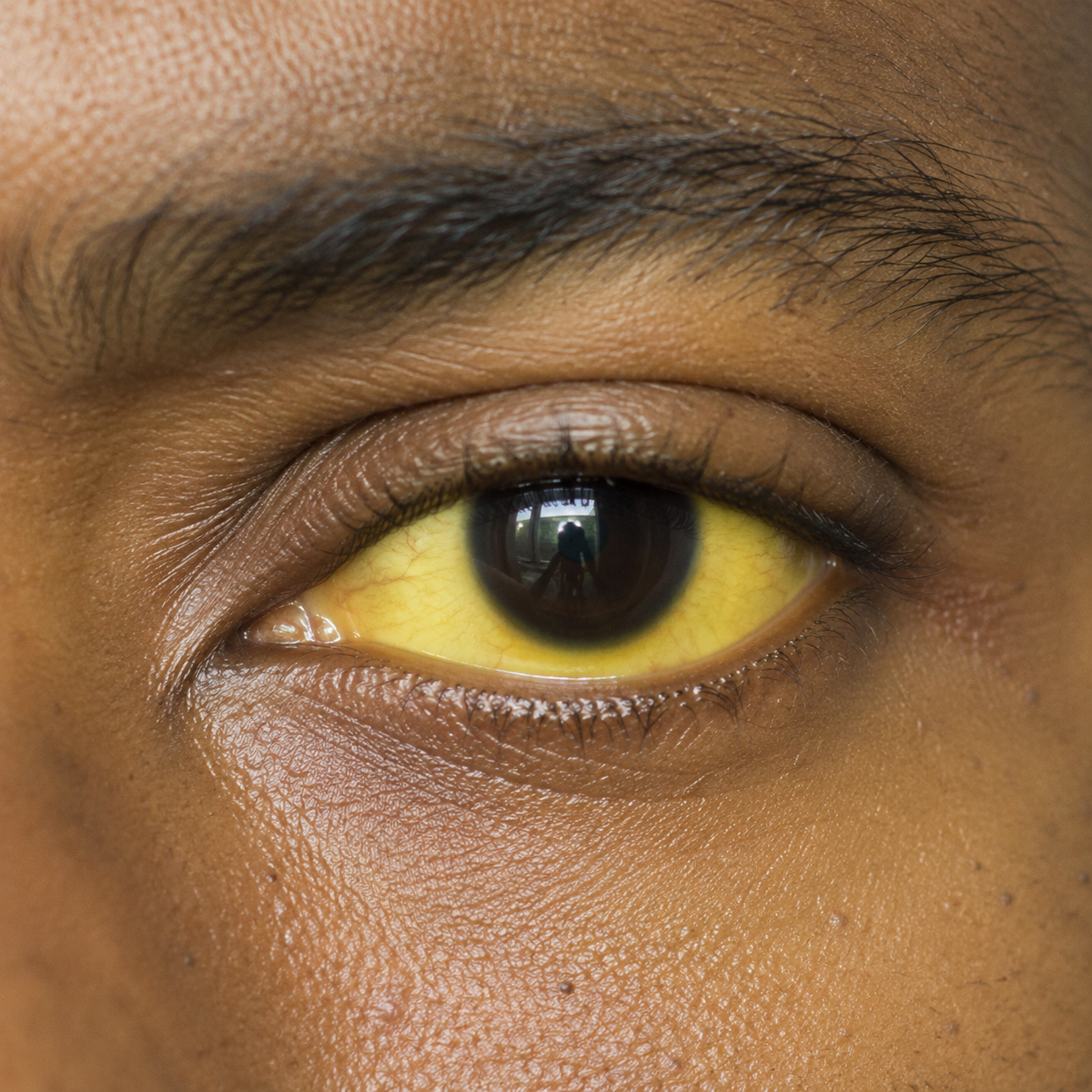 Yellow eyes jaundice